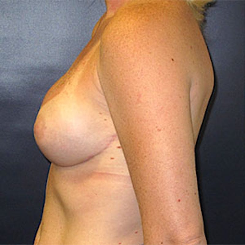Breast Reconstruction Before & After Gallery - Patient 198533 - Image 10