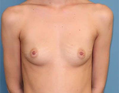 Breast Reconstruction Before & After Gallery - Patient 334905 - Image 1