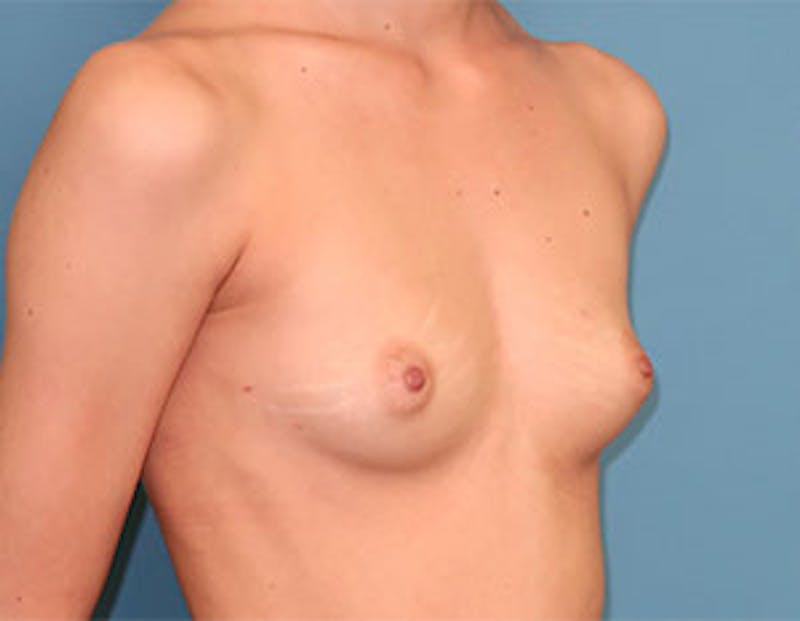 Breast Reconstruction Before & After Gallery - Patient 334905 - Image 3