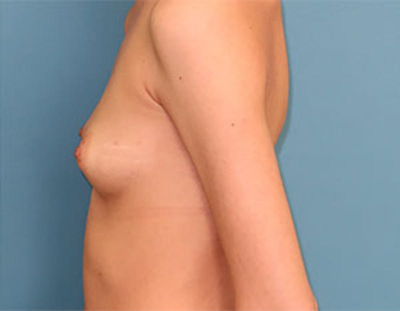 Breast Reconstruction Before & After Gallery - Patient 334905 - Image 9