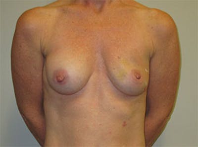 Breast Reconstruction Before & After Gallery - Patient 186883 - Image 1