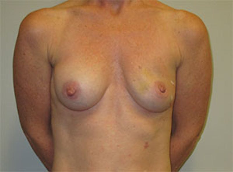 Breast Reconstruction Before & After Gallery - Patient 186883 - Image 1