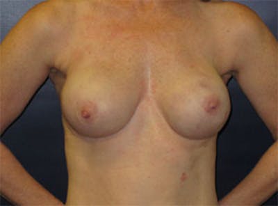 Breast Reconstruction Before & After Gallery - Patient 186883 - Image 2