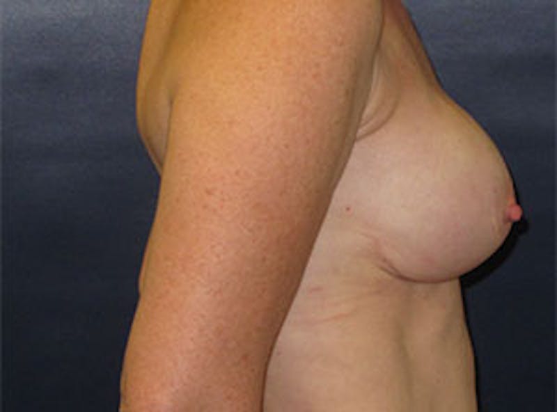 Breast Reconstruction Before & After Gallery - Patient 186883 - Image 4
