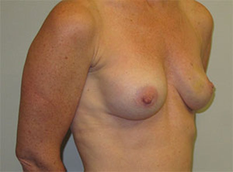 Breast Reconstruction Before & After Gallery - Patient 186883 - Image 5
