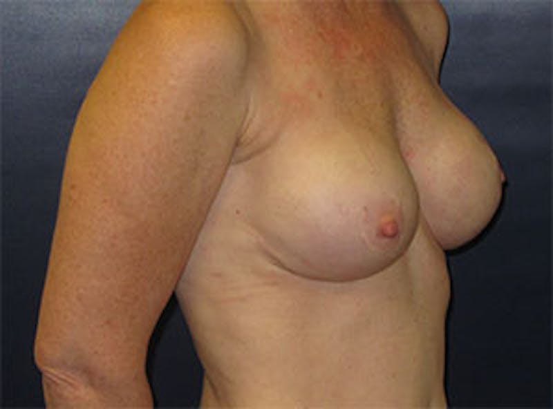 Breast Reconstruction Before & After Gallery - Patient 186883 - Image 6