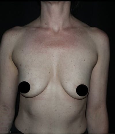 Breast Implants with Lift Before & After Gallery - Patient 225325 - Image 1