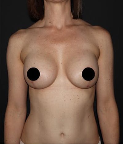 Breast Implants with Lift Before & After Gallery - Patient 225325 - Image 2