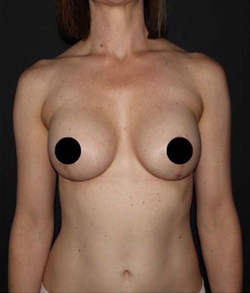 Breast Implants with Lift Before & After Gallery - Patient 225325 - Image 2