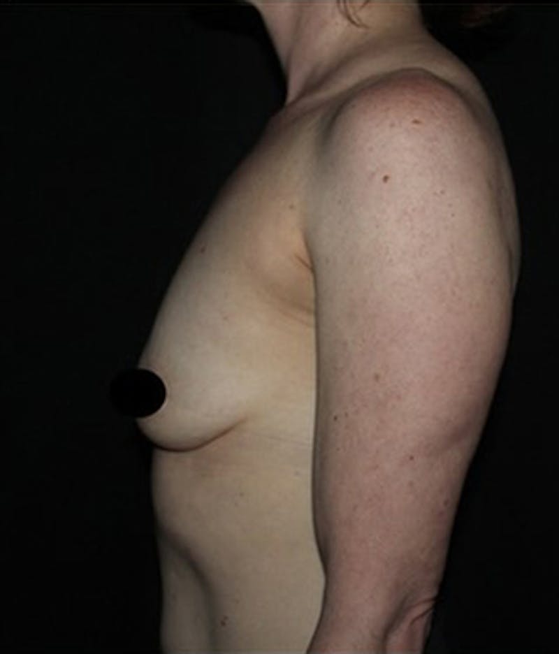 Breast Implants with Lift Before & After Gallery - Patient 225325 - Image 3