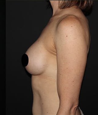 Breast Implants with Lift Before & After Gallery - Patient 225325 - Image 4