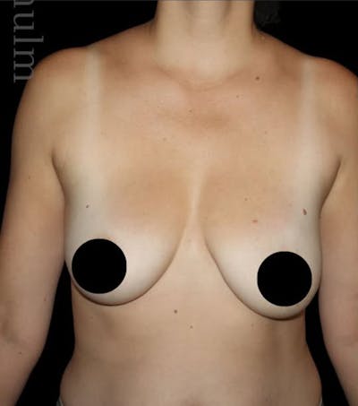 Breast Implants with Lift Before & After Gallery - Patient 370375 - Image 1