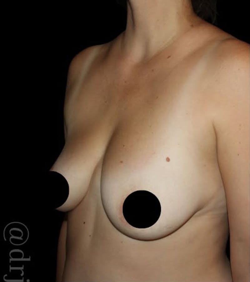 Breast Implants with Lift Before & After Gallery - Patient 370375 - Image 3