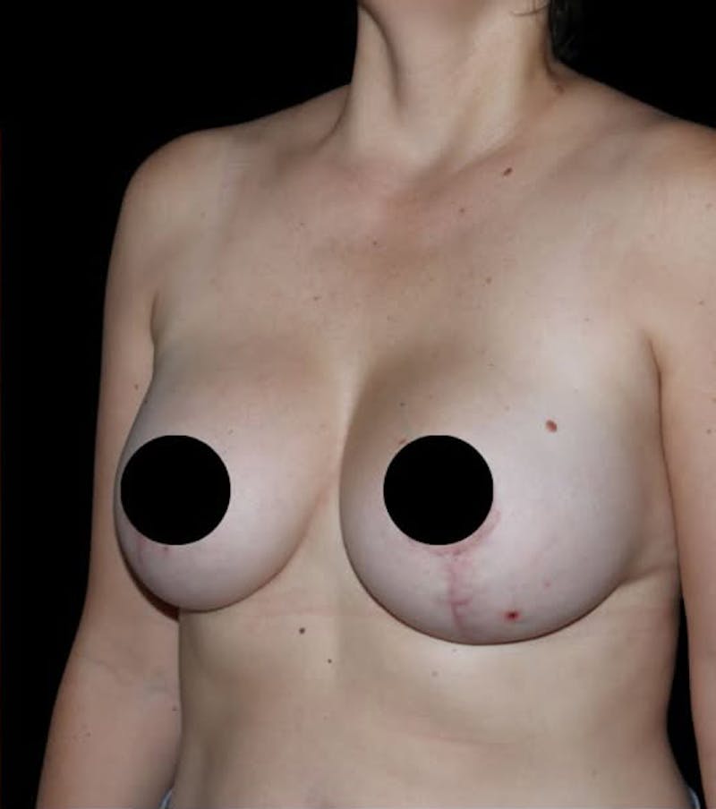 Breast Implants with Lift Before & After Gallery - Patient 370375 - Image 4