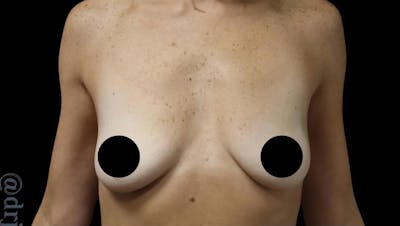 Breast Implants with Lift Before & After Gallery - Patient 405338 - Image 1