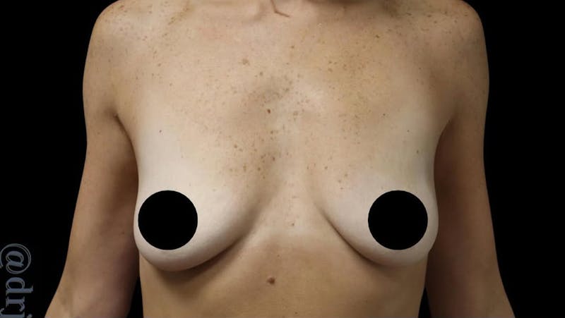 Breast Implants with Lift Before & After Gallery - Patient 405338 - Image 1
