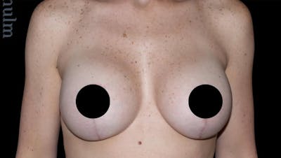 Breast Implants with Lift Before & After Gallery - Patient 405338 - Image 2