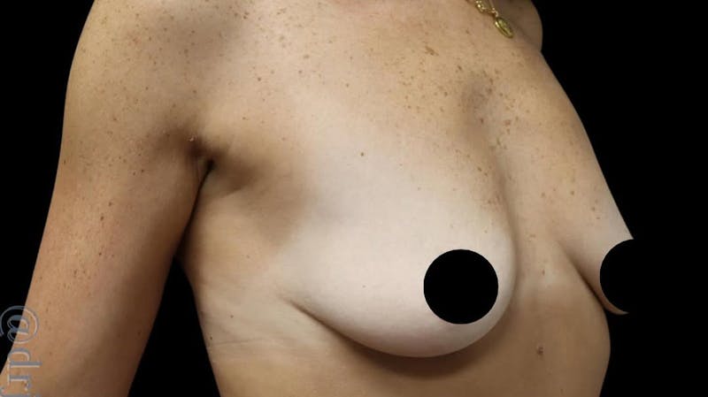Breast Implants with Lift Before & After Gallery - Patient 405338 - Image 3