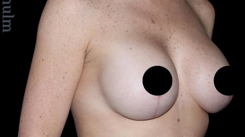 Breast Implants with Lift Before & After Gallery - Patient 405338 - Image 4