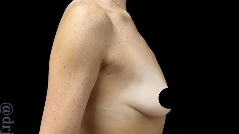 Breast Implants with Lift Before & After Gallery - Patient 405338 - Image 5