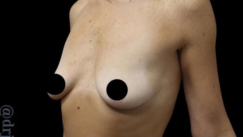Breast Implants with Lift Before & After Gallery - Patient 405338 - Image 7