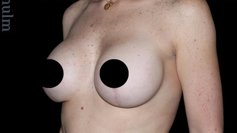 Breast Implants with Lift Before & After Gallery - Patient 405338 - Image 8