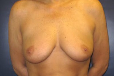Breast Implants with Lift Before & After Gallery - Patient 393169 - Image 1