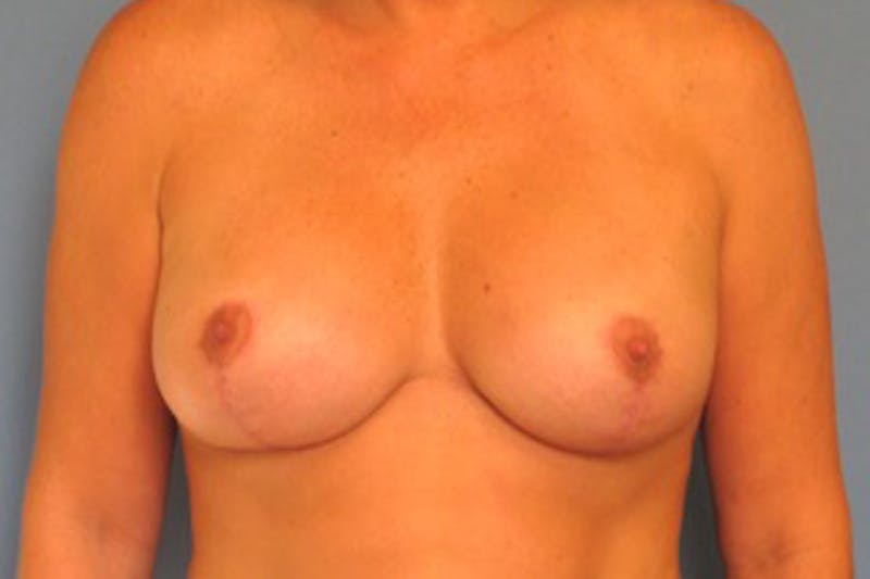 Breast Implants with Lift Before & After Gallery - Patient 393169 - Image 2
