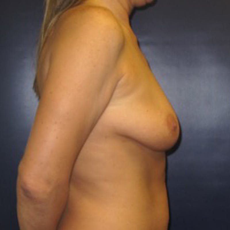 Breast Implants with Lift Before & After Gallery - Patient 393169 - Image 5