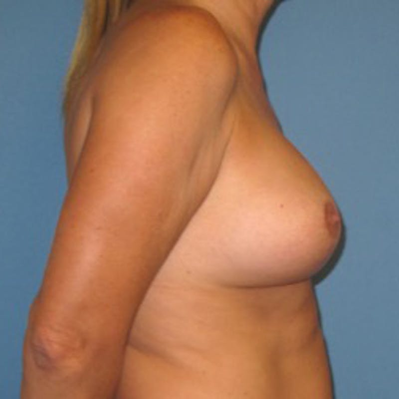 Breast Implants with Lift Before & After Gallery - Patient 393169 - Image 6