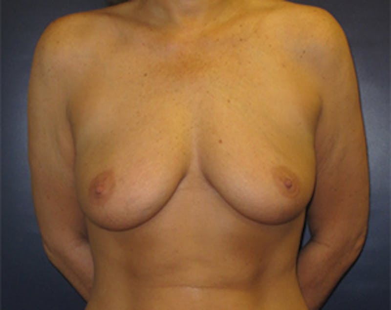 Breast Implants with Lift Before & After Gallery - Patient 536037 - Image 1