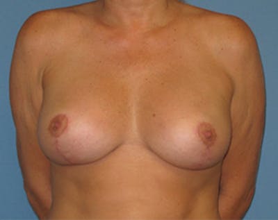 Breast Implants with Lift Before & After Gallery - Patient 536037 - Image 2