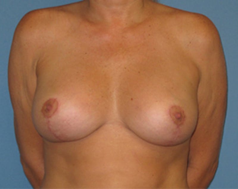 Breast Implants with Lift Before & After Gallery - Patient 536037 - Image 2