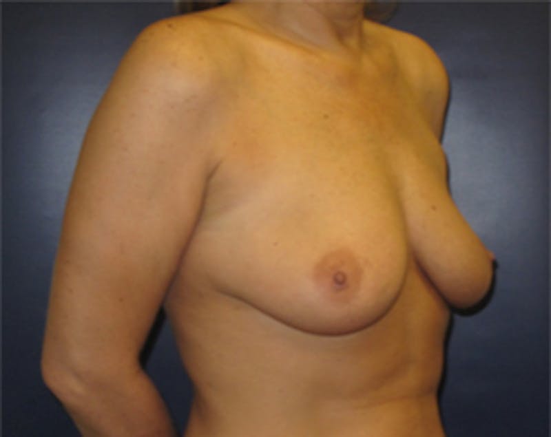 Breast Implants with Lift Before & After Gallery - Patient 536037 - Image 3