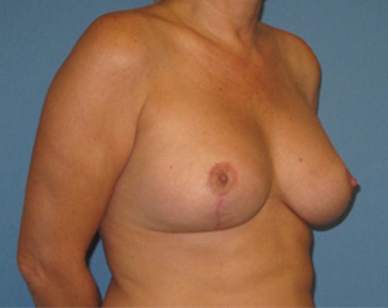 Breast Implants with Lift Before & After Gallery - Patient 536037 - Image 4