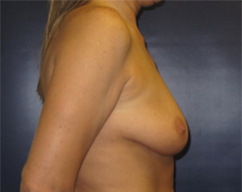 Breast Implants with Lift Before & After Gallery - Patient 536037 - Image 7