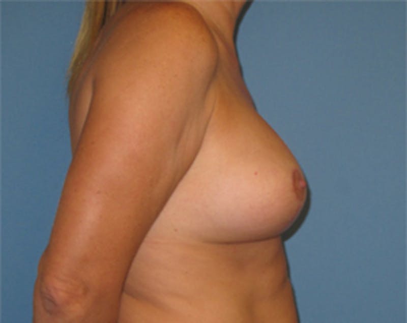 Breast Implants with Lift Before & After Gallery - Patient 536037 - Image 8