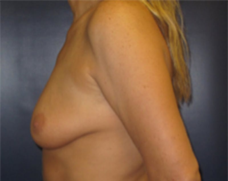 Breast Implants with Lift Before & After Gallery - Patient 536037 - Image 9