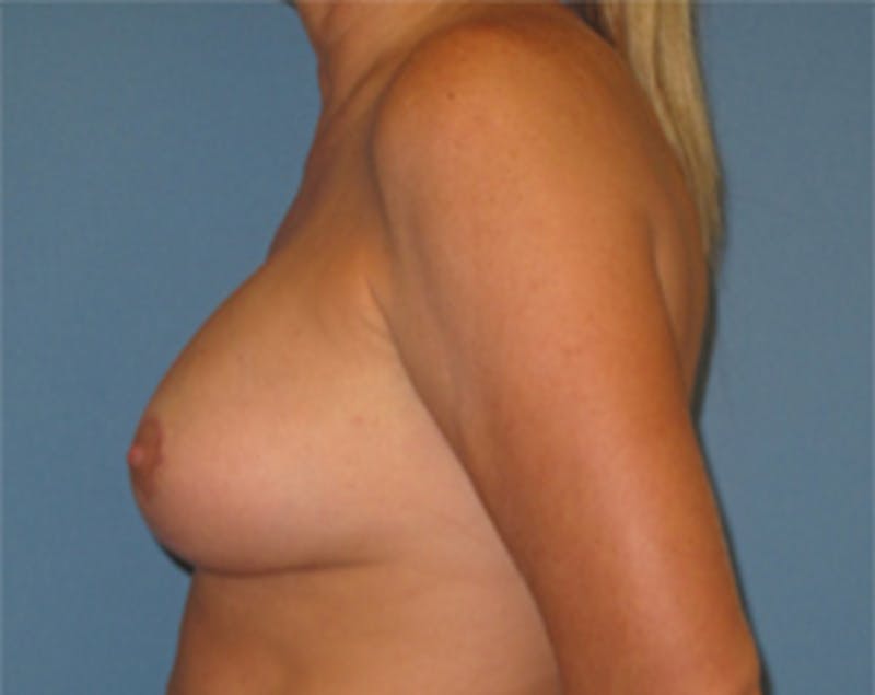 Breast Implants with Lift Before & After Gallery - Patient 536037 - Image 10