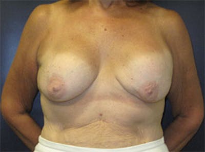Breast Implant Exchange Before & After Gallery - Patient 405004 - Image 1