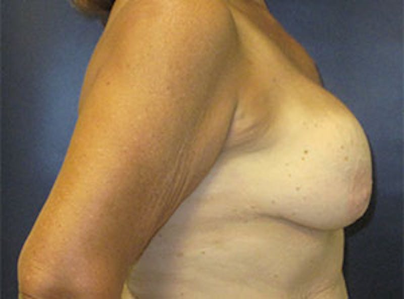 Breast Revision Before & After Gallery - Patient 835151 - Image 3