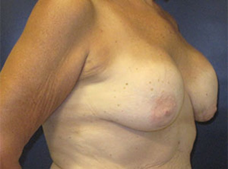 Breast Revision Before & After Gallery - Patient 835151 - Image 5