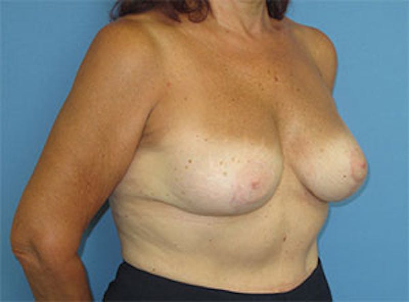 Breast Revision Before & After Gallery - Patient 835151 - Image 6