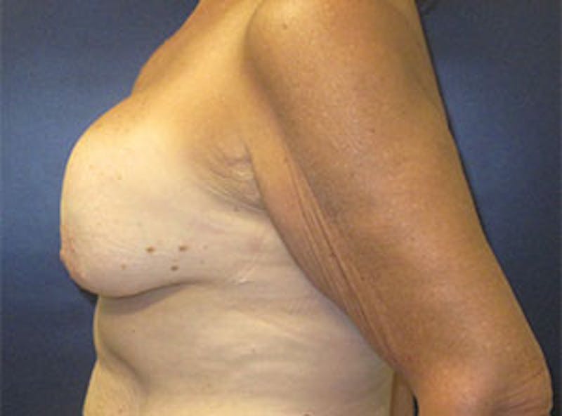 Breast Revision Before & After Gallery - Patient 835151 - Image 7