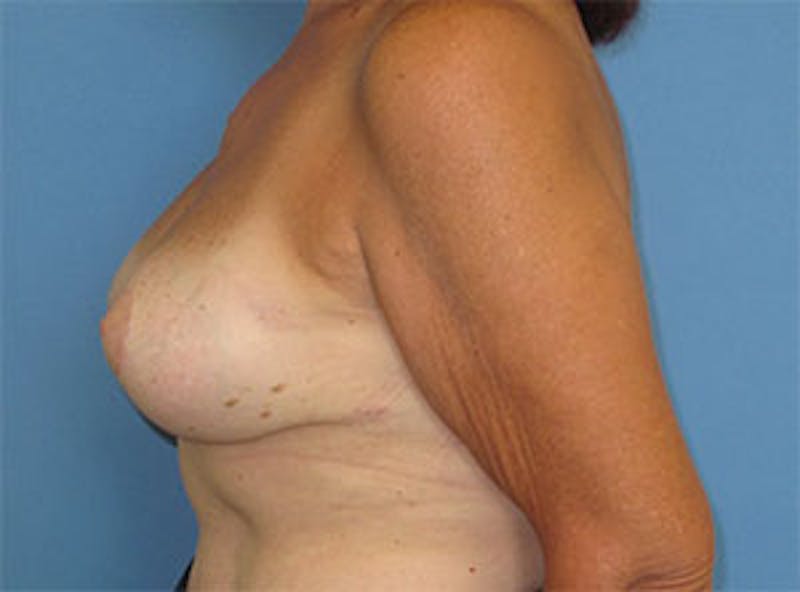 Breast Revision Before & After Gallery - Patient 835151 - Image 8