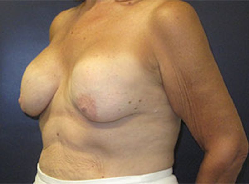 Breast Revision Before & After Gallery - Patient 835151 - Image 9