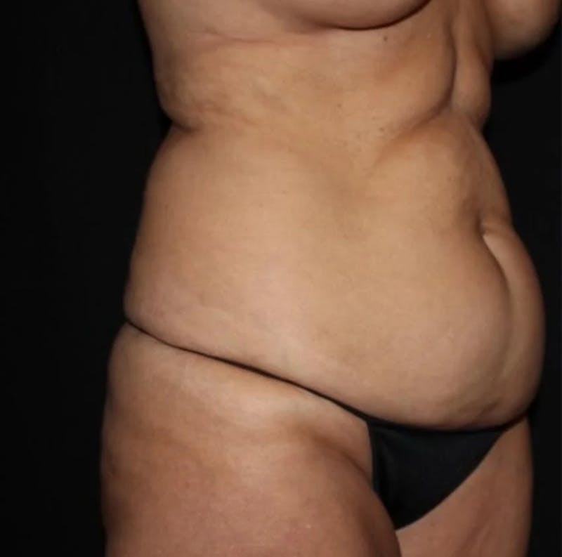 Tummy Tuck Before & After Gallery - Patient 250639 - Image 1