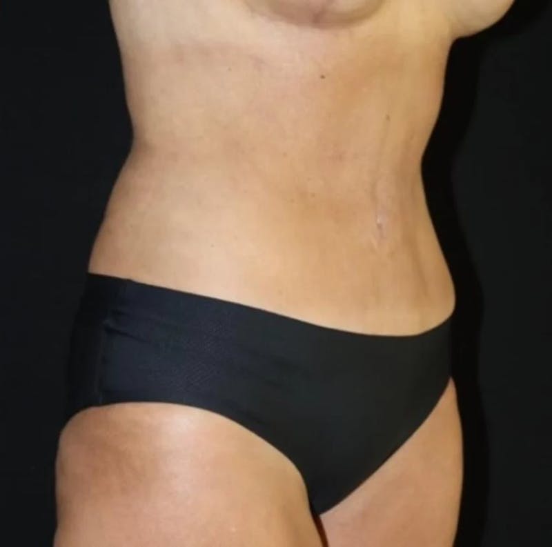 Tummy Tuck Before & After Gallery - Patient 250639 - Image 2