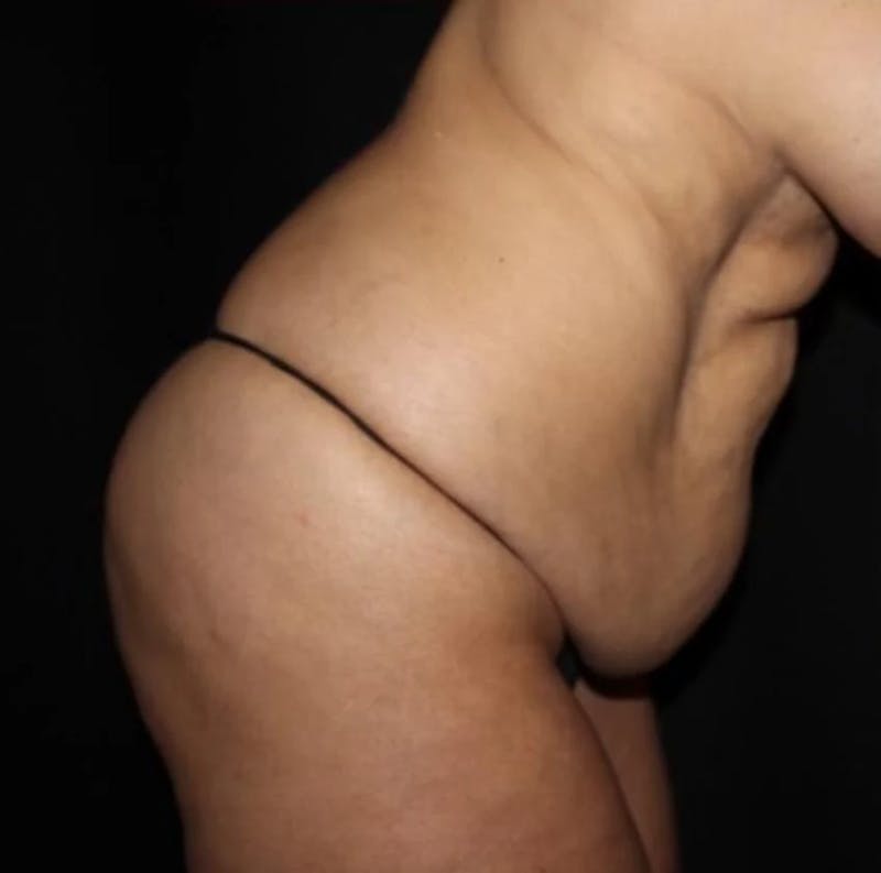 Tummy Tuck Before & After Gallery - Patient 250639 - Image 3