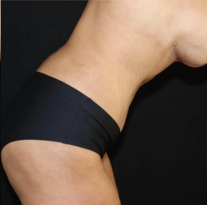 Tummy Tuck Before & After Gallery - Patient 250639 - Image 4